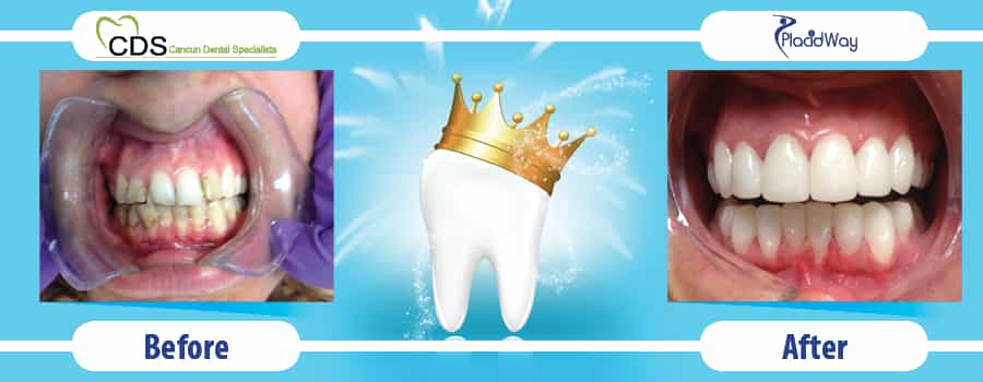 Before and After Dental Implants in Cancun Mexico Before and After Dental Implants in Cancun Mexico